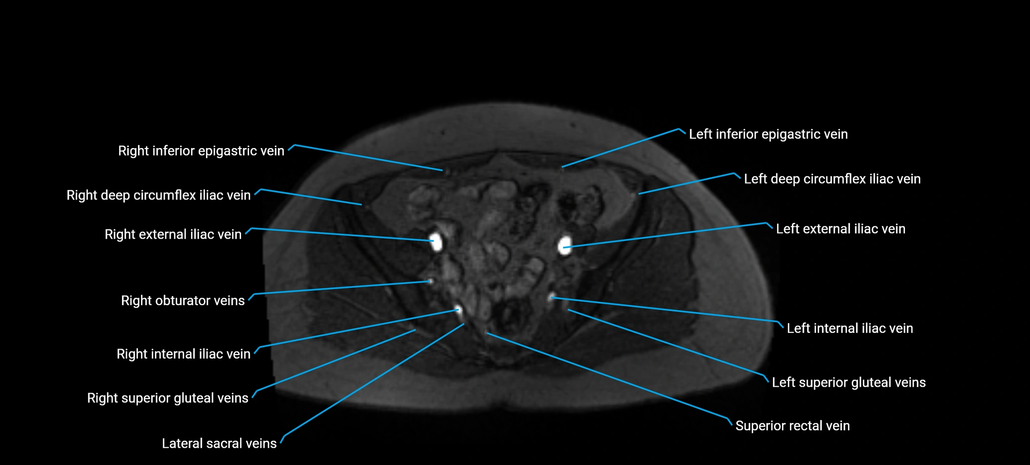 MRV abdomen pelvis & lower limb axial cross sectional anatomy labelled MRI image 149 (1).webp